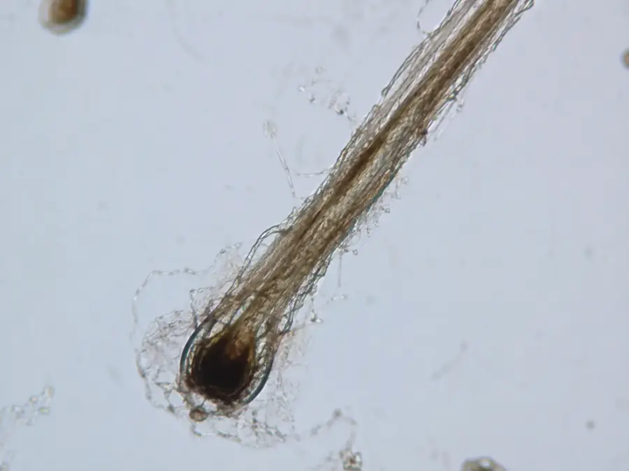 CHUTE DE CHEVEUX 3 MYLAAEVANS Racine d’un cheveu prélevé, vue au microscope pendant un bilan du cuir chevelu